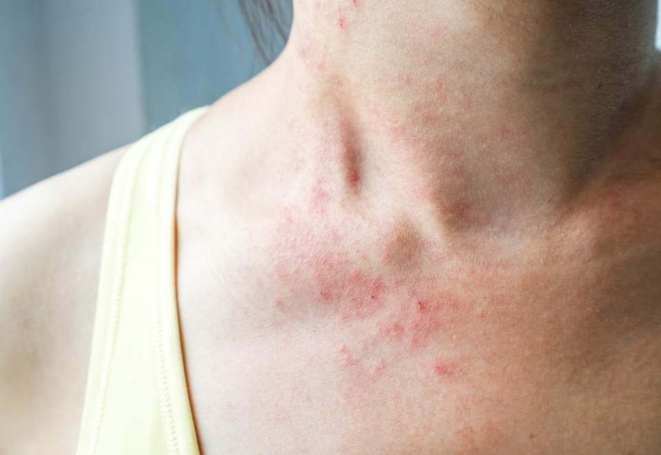 Eczema on the neck