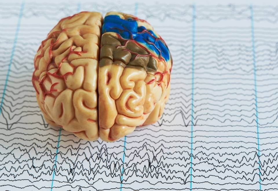 Photo of brian simulating epilepsy in the brain